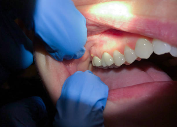 Best Emergency Dental Care for Broken or Chipped Teeth in Ntgomery City, MO