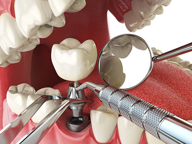 Best Emergency Treatment for Dental Infections or Abscesses in Ntgomery City, MO